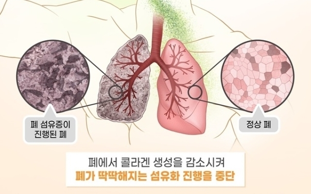 폐 섬유증 그래픽. /대웅제약